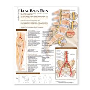 Understanding Lower Back Pain 20x26" Anatomical Chart Ea