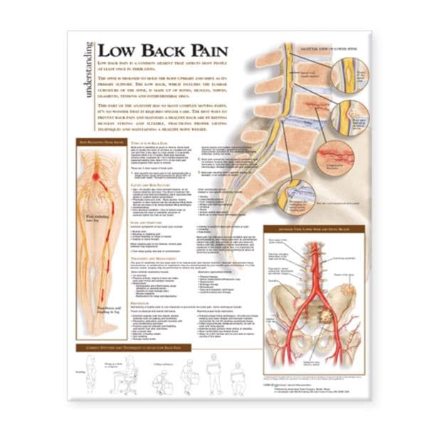 Understanding Lower Back Pain 20x26" Anatomical Chart Ea