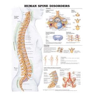 Human Spine Disorders 20x26" Anatomical Chart Ea