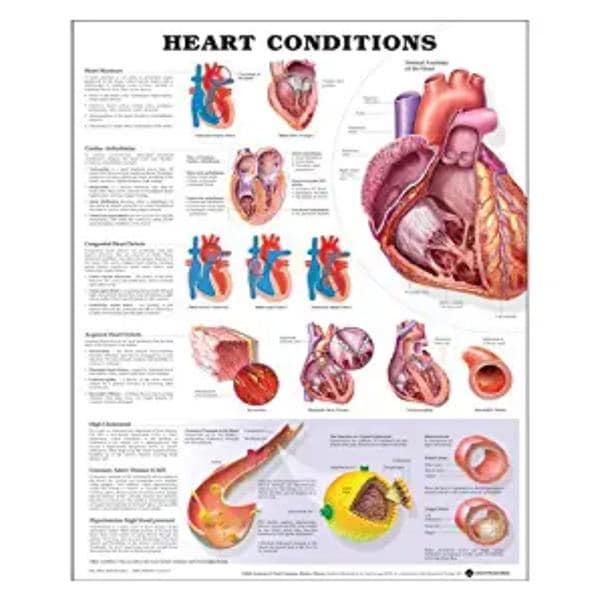 Heart Conditions 20x26" Anatomical Chart Ea