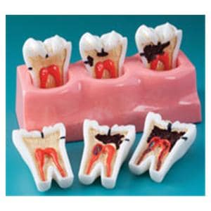 Patient Education Model Caries Progression 2 1/8 in x 5 1/2 in Ea