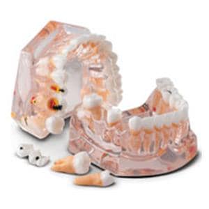 Patient Education Model Caries Evolution 3.5 in x 4.25 in Ea