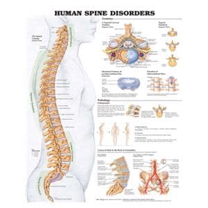 Human Spine Disorders 20x26" Anatomical Chart Ea