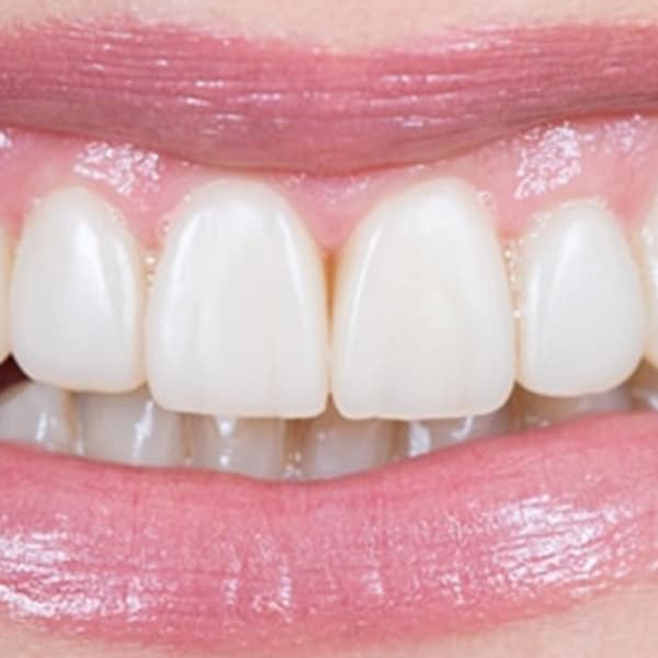 DENTAL COMPOSITES AND RESTORATIVES