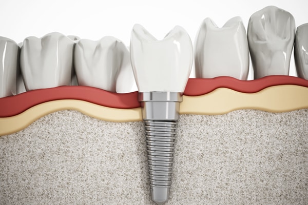 Dental Implants & Abutments