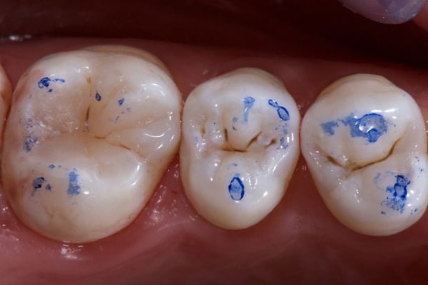 Dental Articulating Paper and Dental Occlusion Corrections