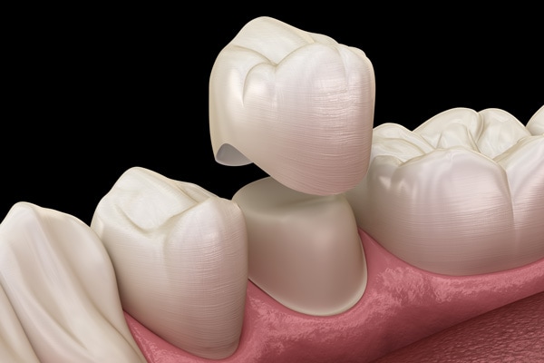 Dental Crowns and Bridges