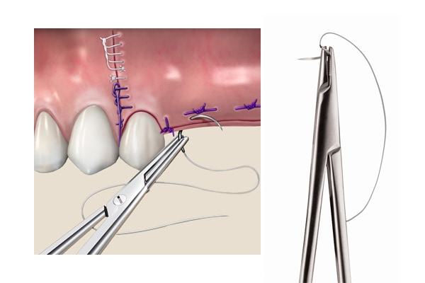 Hu-Friedy's Sutures